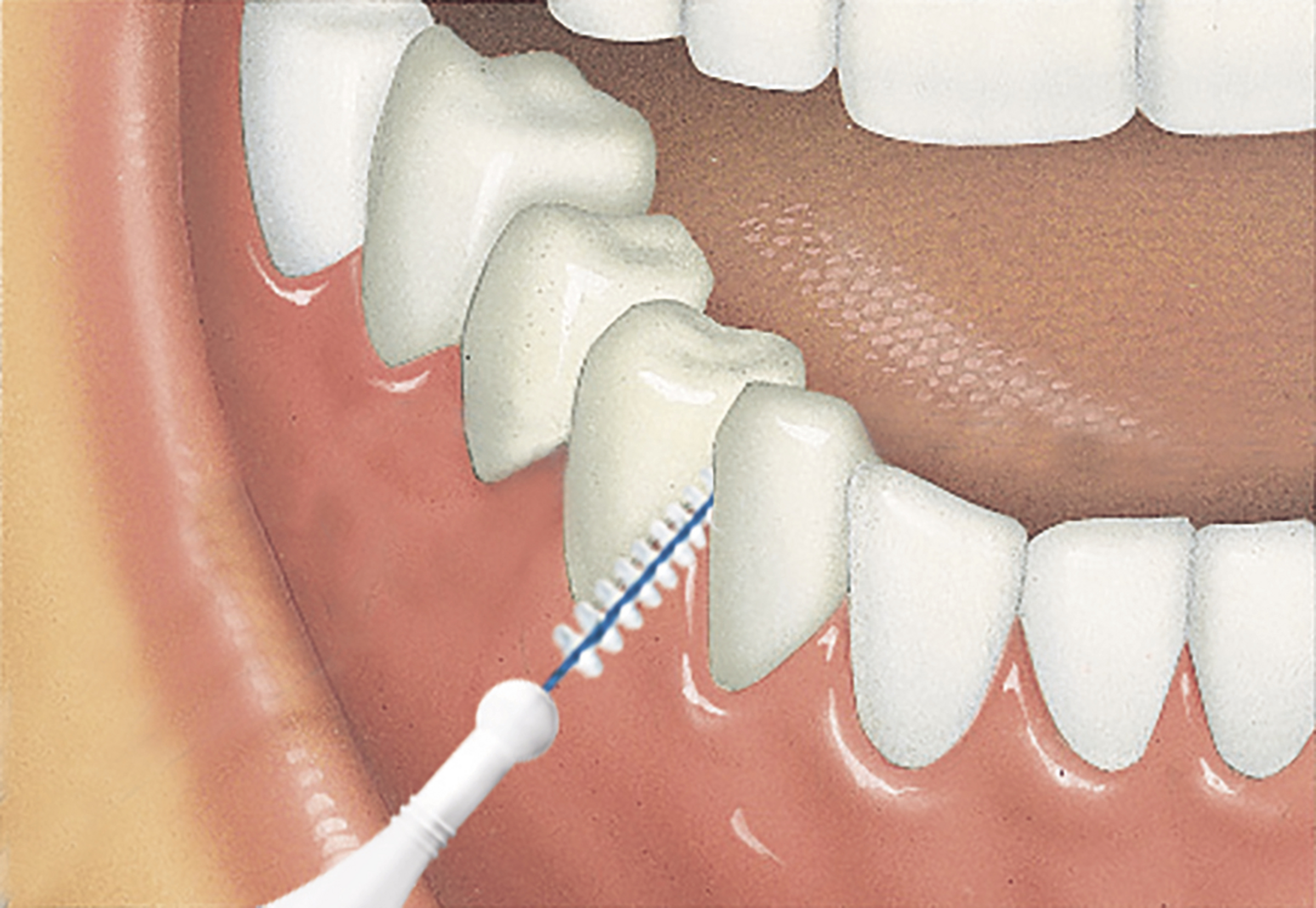 TRAV-LER® فرشاة أسنان بين الأسنان التنوب 1.1 مم أخضر 3