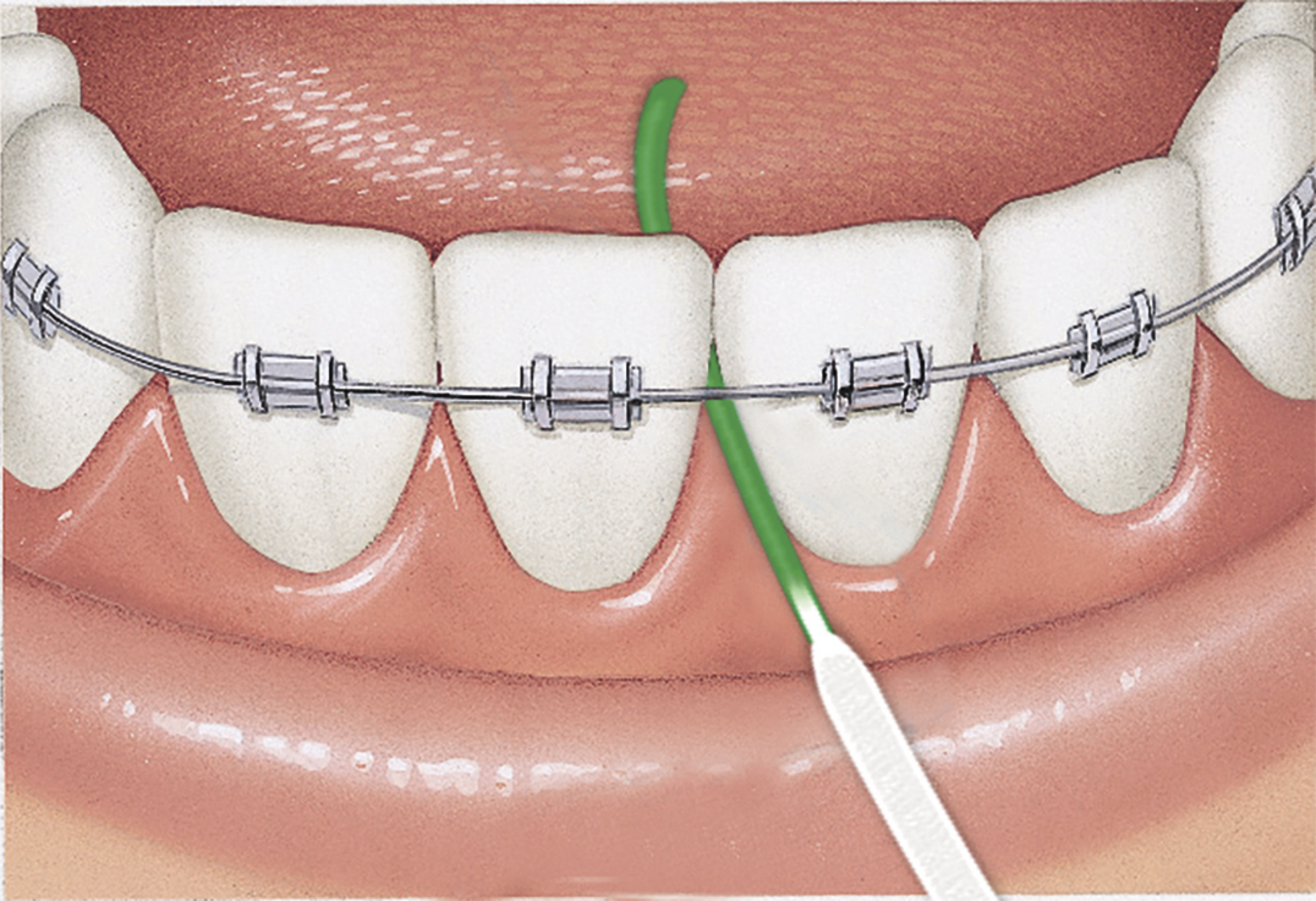 خيط تنظيف الأسنان ACCESS FLOSS مع أداة إدخال لـ 50 استخدامًا 6