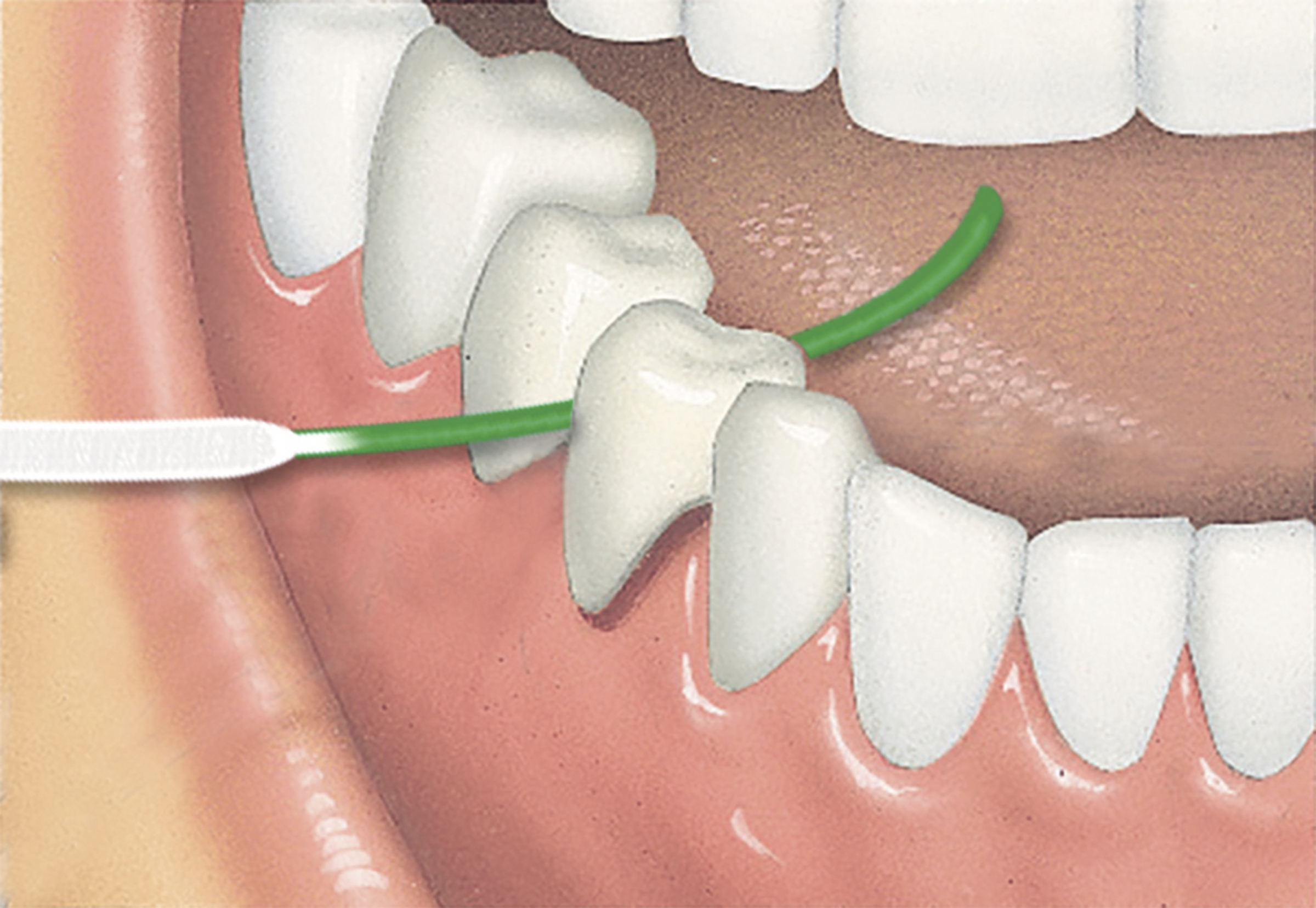 خيط تنظيف الأسنان ACCESS FLOSS مع أداة إدخال لـ 50 استخدامًا 4