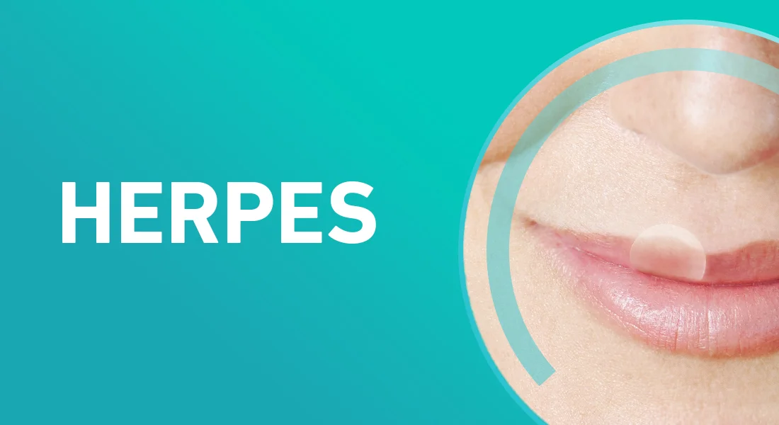 Herpes